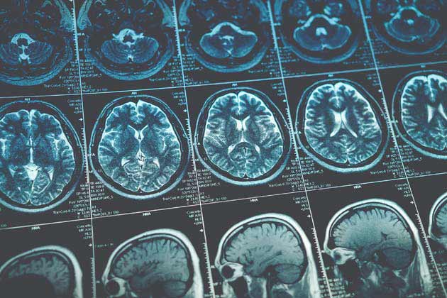 Brain Tumor