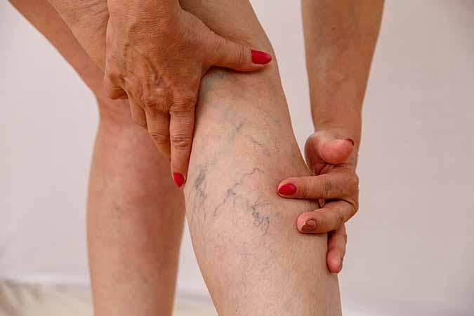 Distended Veins