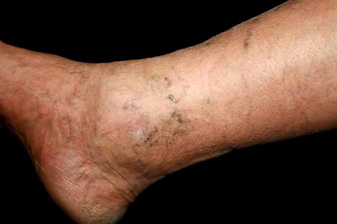 Swelling
