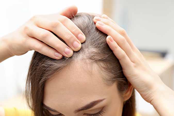 Hair Loss