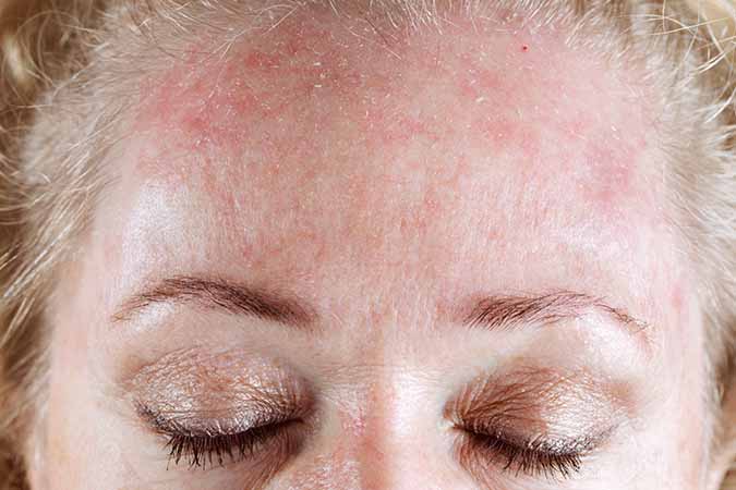 Dry Skin